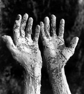 Hands with skin whitened with leprosy
