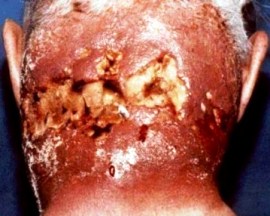 Man with severe boils covering the back of his neck