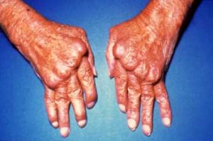 hands-arthritic