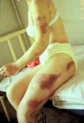 Injuries arising from rape of a young woman
